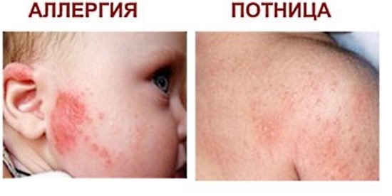 Акне у новорожденных. Признаки, как выглядит, фото на лице, голове, груди, спине. Как отличить от аллергии, чем лечить, мази, народные средства, уход за кожей ребенка