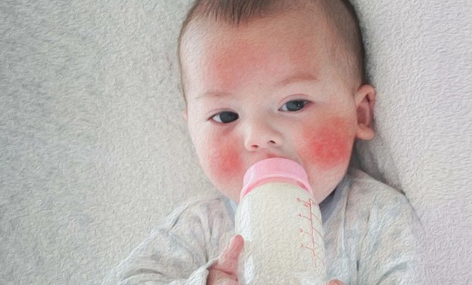 Аллергия на молоко у ребенка. Симптомы, фото