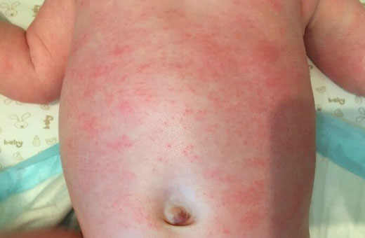 Аллергия на порошок у ребенка. Фото, как проявляется. Симптомы и лечение