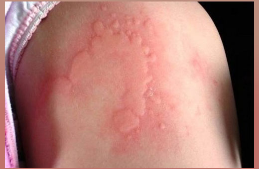 Аллергия на порошок у ребенка. Фото, как проявляется. Симптомы и лечение