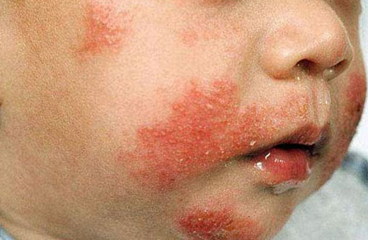 Аллергия на порошок у ребенка. Фото, как проявляется. Симптомы и лечение