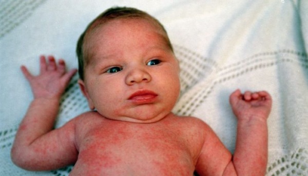 Аллергия у новорожденных. Фото на лице, теле, возле рта. Симптомы и лечение