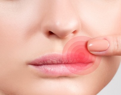 трещины в уголках рта