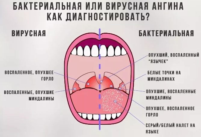 Антибиотики при ангине у детей. Названия. Список препаратов без рецептов