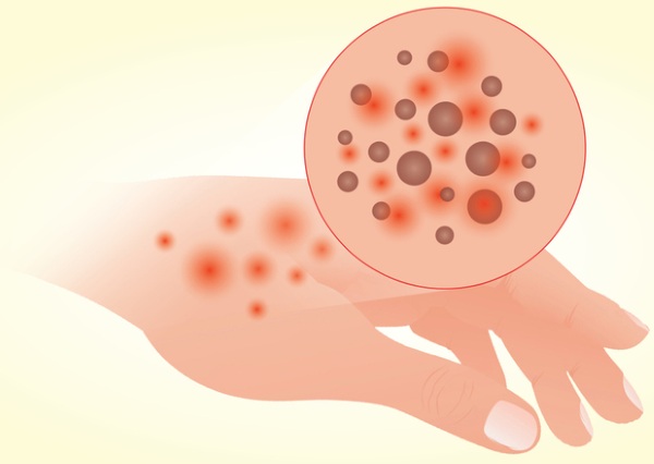 Атопический дерматит у грудничка. Симптомы, фото, стадии, чем лечить, диета