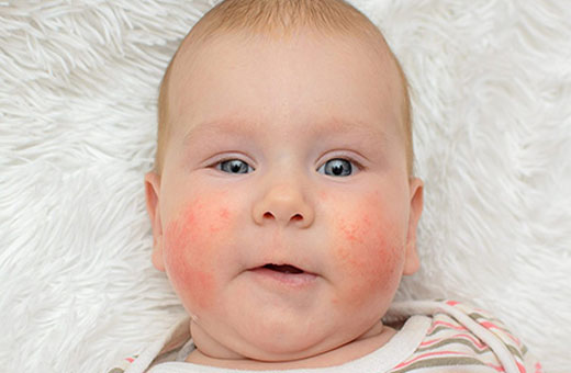 Сыпь на щеках у грудного ребенка. Фото, что это значит, что делать, как лечить
