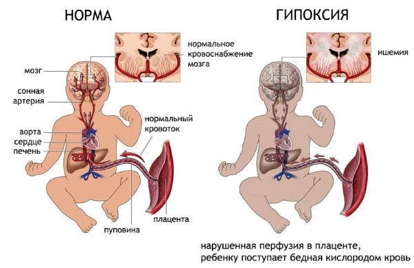 Бандаж для беременных. Какой выбрать, как правильно носить универсальный, дородовой, послеродовой, трусы, пояс-бандаж, поддерживающий
