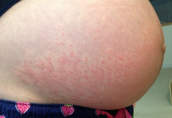 Бандаж для беременных. Какой выбрать, как правильно носить универсальный, дородовой, послеродовой, трусы, пояс-бандаж, поддерживающий