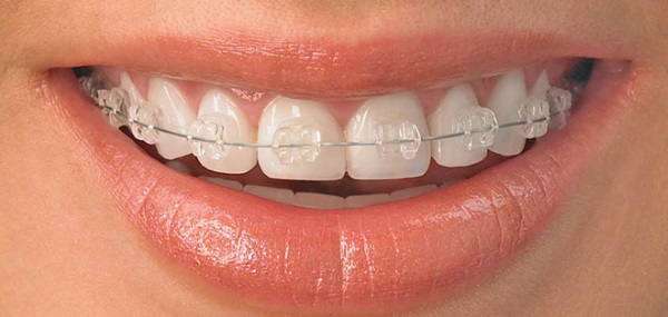 Белые пятна на зубах у ребенка. Причины и что делать, как избавится от пятен после отбеливания, брекетов, чистки, полосок