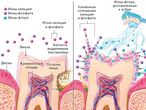 Белые пятна на зубах у ребенка. Причины и что делать, как избавится от пятен после отбеливания, брекетов, чистки, полосок