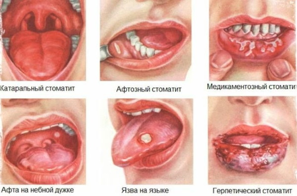 Белый налет на языке у детей. Причины, как лечить при простуде, температуре, до года
