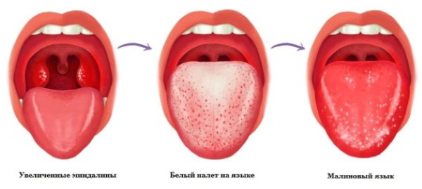 Белый налет на языке у детей. Причины, как лечить при простуде, температуре, до года