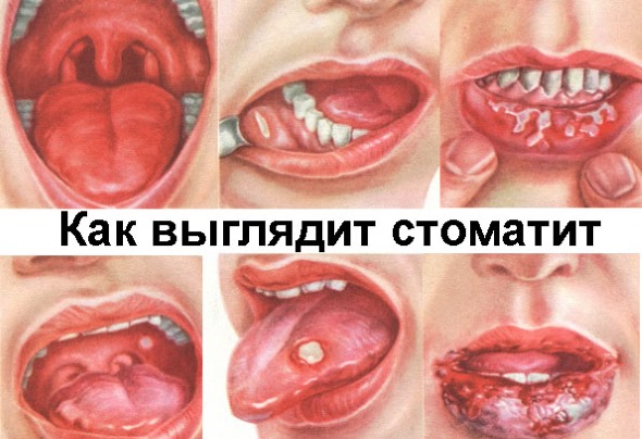 Белый налет на языке у новорожденного. Причины при грудном, искусственном, смешанном вскармливании. Как почистить