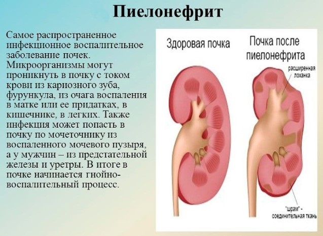 Боль в пояснице при беременности в первом, втором, третьем триместре. Лечение