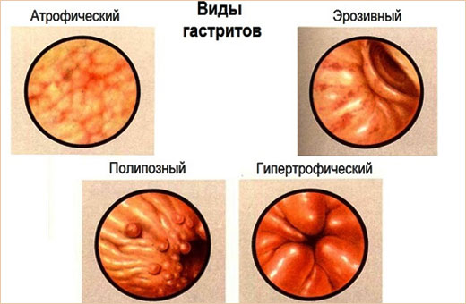 Боли в желудке при беременности. Что делать, что можно принимать, как лечить