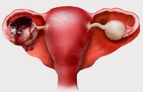 Болит яичник при беременности на ранних, поздних сроках. Что делать, как лечить