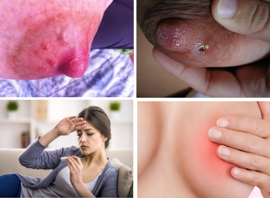 Бугорки Монтгомери при беременности. То это такое, фото, причины появления, воспаление