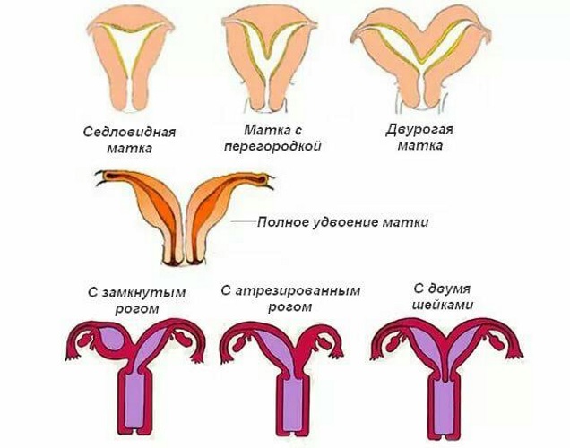 Двурогая матка и беременность. Что это такое, причины у женщин, как выглядит, что значит, плохо ли, можно ли забеременеть