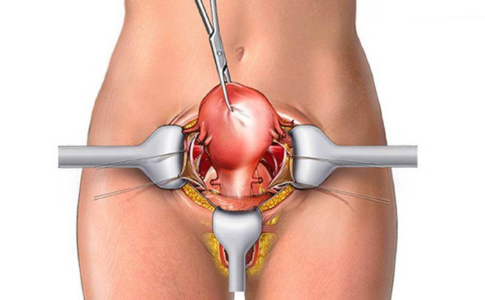 Экстирпация матки с придатками: что это такое, последствия