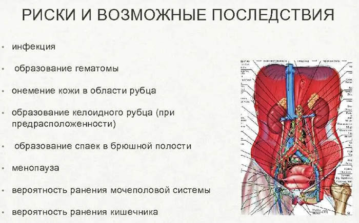 Экстирпация матки с придатками: что это такое, последствия