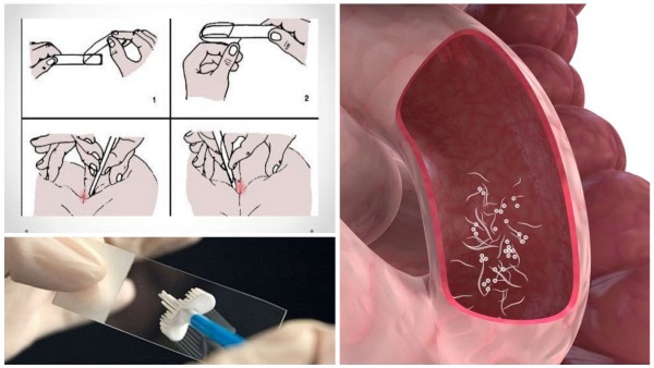 Энтеробиоз у детей. Симптомы и лечение народными средствами, таблеткой, препараты. Как сдавать анализ, как берут соскоб. Последствия