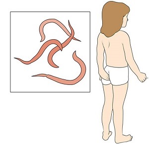 Энтеробиоз у детей. Симптомы и лечение народными средствами, таблеткой, препараты. Как сдавать анализ, как берут соскоб. Последствия