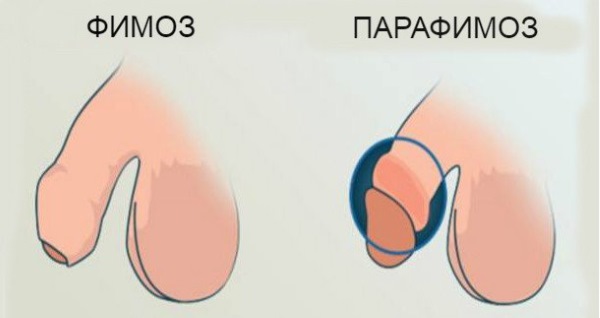 Фимоз у мальчиков. Фото, что это такое, лечение в домашних условиях, операция