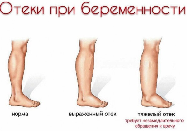 Фитолизин Пренатал при беременности от отеков. Инструкция, как принимать, аналоги