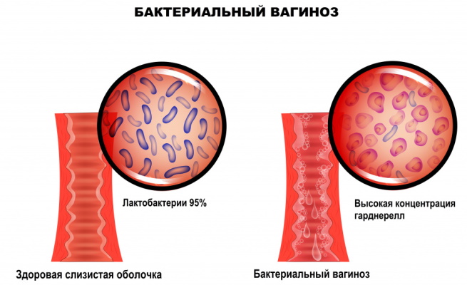 Флуомизин свечи при беременности 1-2-3 триместр. Отзывы
