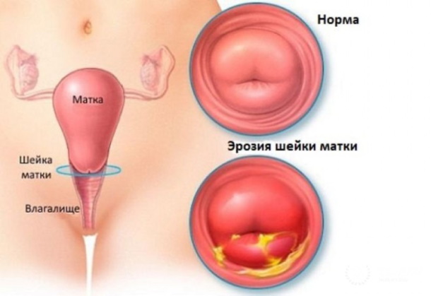 Флуомизин свечи при беременности 1-2-3 триместр. Отзывы