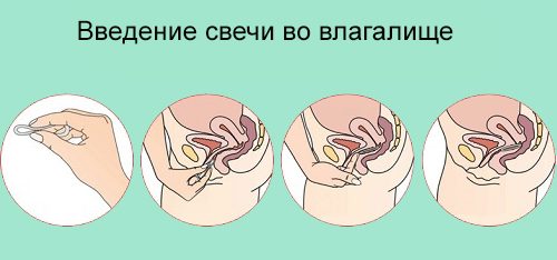 Флуомизин свечи при беременности 1-2-3 триместр. Отзывы