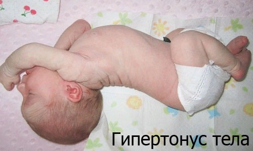 Гипертонус мышц у грудничков. Что это, симптомы и лечение, массаж ног, лица, шеи, спины