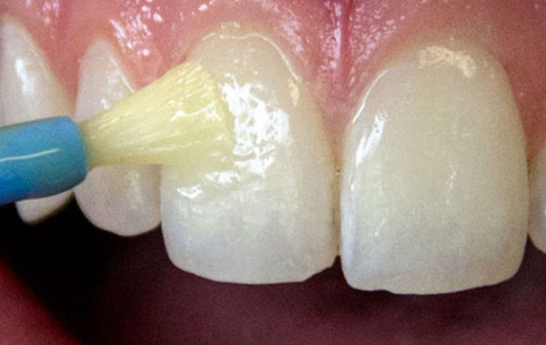 Гнилые (плохие) зубы у детей. Какие витамины пить, причины, что делать