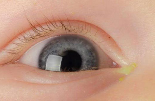 Гноится глаз у новорожденного. Чем лечить дома. Советы врачей, Комаровского