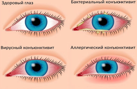 Гноится глаз у новорожденного. Чем лечить дома. Советы врачей, Комаровского