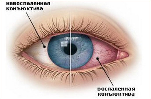 Гноится глаз у новорожденного. Чем лечить дома. Советы врачей, Комаровского