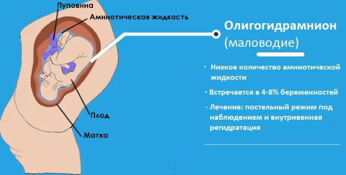 СЗРП при беременности. Что это такое в 30-38 недели, что делать