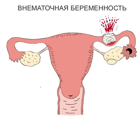 Имплантационное кровотечение. Фото, что это такое, у всех ли бывает, когда делать тест на беременность, на какой день происходит после переноса эмбрионов