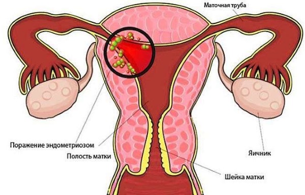 Имплантационное кровотечение. Фото, что это такое, у всех ли бывает, когда делать тест на беременность, на какой день происходит после переноса эмбрионов
