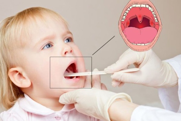 Ингаляции от кашля для детей. Рецепты с содой, картошкой, Амбробене, Беродуалом, физраствором