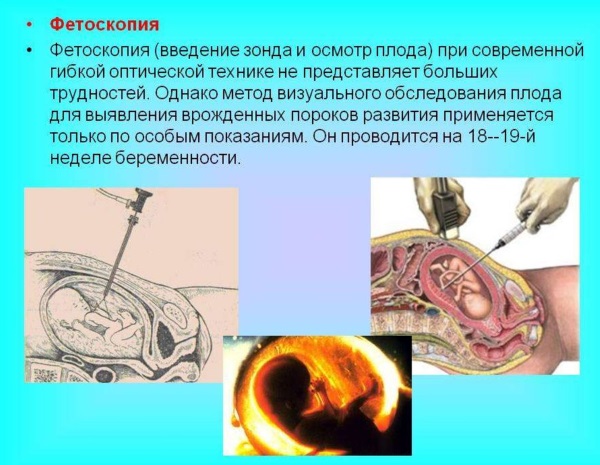 Инвазивная диагностика при беременности. Что это такое, как делают, больно или нет