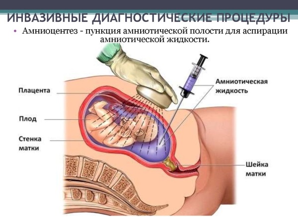 Инвазивная диагностика при беременности. Что это такое, как делают, больно или нет