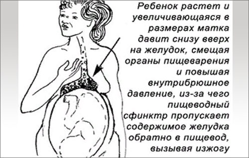 Изжога при беременности. Причины, как избавиться, лечение: народные средства, препараты