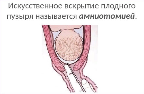 Как отходят воды у беременных перед родами. Признаки, как выглядит, какого цвета у перво-, повторнородящих. Подтекание околоплодных вод