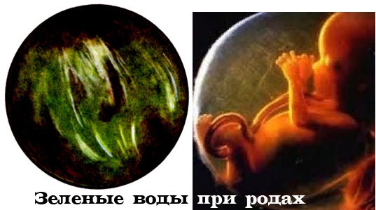 Как отходят воды у беременных перед родами. Признаки, как выглядит, какого цвета у перво-, повторнородящих. Подтекание околоплодных вод