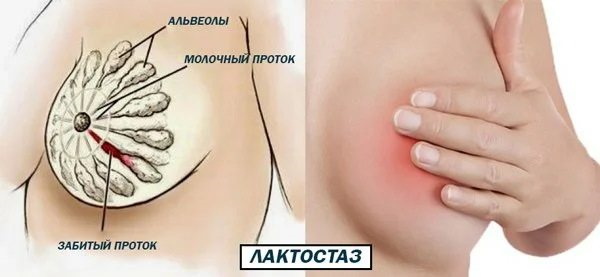 Как перевязать грудное молоко, чтобы перегорело без боли, быстро