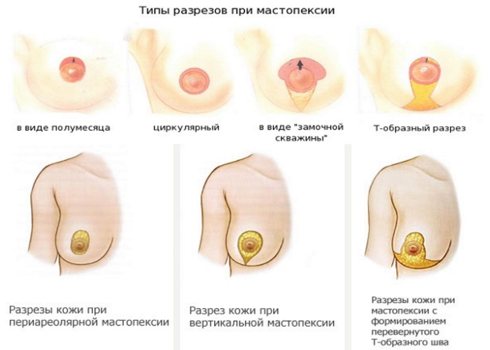 Как восстановить грудь после кормления, подтянуть после родов