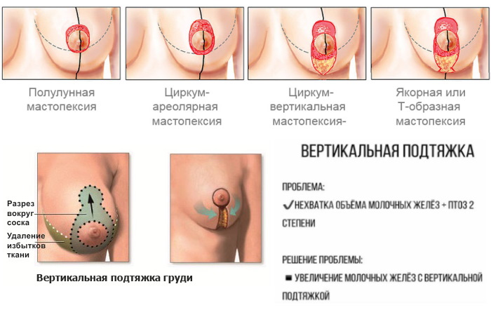 Как восстановить грудь после кормления, подтянуть после родов