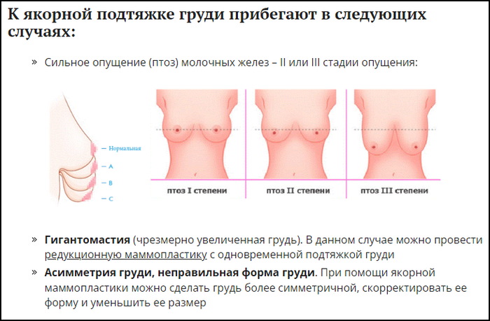Разрез по своей форме напоминает якорь, из-за чего и получил свое название.