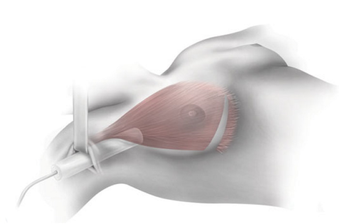 Как восстановить грудь после кормления, подтянуть после родов